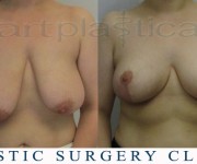 Breast Reduction - After 2 months