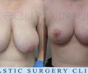 Breast Reduction - 2 months after surgery - Beauty Group