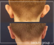 Ear correction - otoplasty - Beauty Group