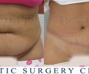 Tummy tuck -3 months after