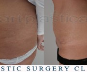 Beauty Group - Artplastica - Abdominoplasty (Tummy Tuck) - before and after