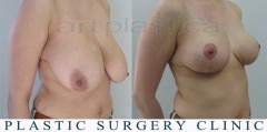 Breast reduction - before and after surgery
