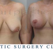 Breast uplift - mastopexy (1 month after) - Beauty Group