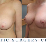 Breast uplift - mastopexy (2 months after)