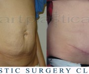 Tummy tuck -2 months after