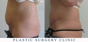 Abdominoplasty (Tummy Tuck) - before and after pictures