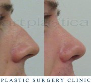 Nose correction (Rhinoplasty)