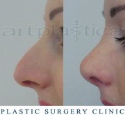 Nose correction (Rhinoplasty) 