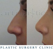 Nose correction (Rhinoplasty) 