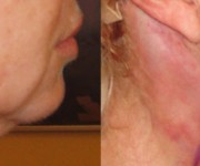 Chin & Neck correction gallery