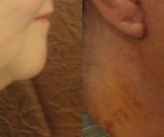 Chin & Neck correction gallery
