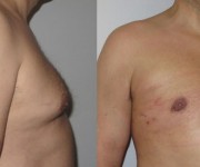 Before and After photo male breast reduction - gynecomastia