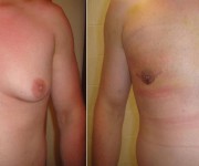 Before and After photo male breast reduction - gynecomastia