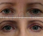 After and before eyelid correction photo