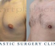 Before and After photo male breast reduction - gynecomastia 