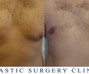 Before and After photo - male breast reduction - gynecomastia - Beauty Group