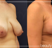 Breast enlargement with mastopexy