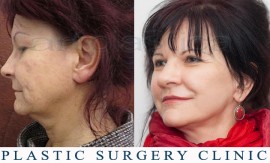 Beauty Group - Artplastica - Face lift and upper eyelid correction