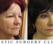 Beauty Group - Artplastica - Face lift and upper eyelid correction