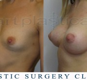 Breast enlargement, nipple correction