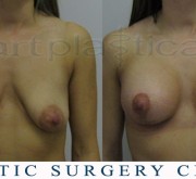 Breast enlargement with mastopexy - Beauty Group - Artplastica