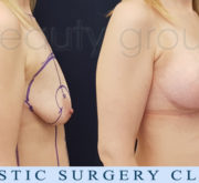 Breast enlargement with mastopexy - Beauty Group
