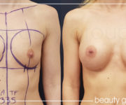 Breast-enlargement 