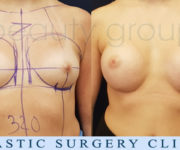 Breast enlargement - photo before and after surgery - Beauty Group