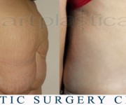 Abdominoplasty (Tummy Tuck) - before and after 5 years