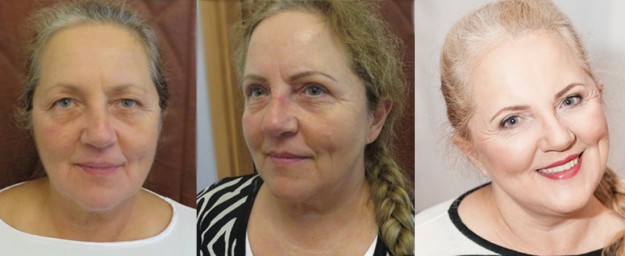 Pictures - before surgery - after upper eyelid correction - after Face lift 