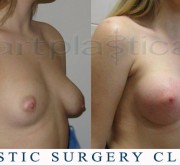 Breast enlargement (asymmetry) - photo before and after surgery