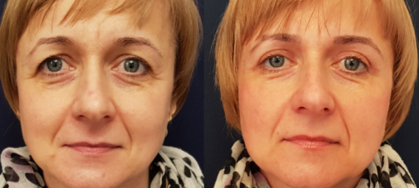 Eyelid correction