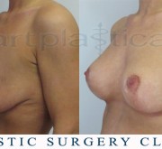 Breast enlargement with mastopexy