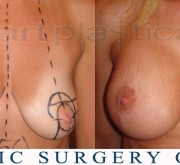 Breast enlargement with mastopexy