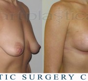 Breast enlargement with mastopexy