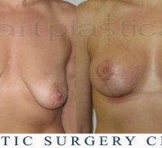 Breast enlargement with mastopexy