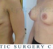 Breast enlargement with mastopexy