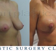 Breast enlargement with mastopexy - A few days after surgery