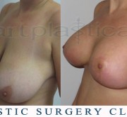 Breast enlargement with mastopexy