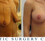 Breast enlargement with mastopexy