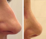 Rhinoplasty