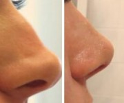 Rhinoplasty