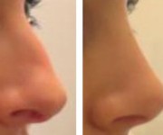 Rhinoplasty