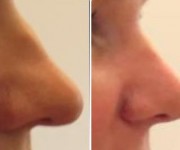 Rhinoplasty