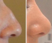 Rhinoplasty