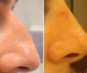 Rhinoplasty