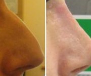 Rhinoplasty