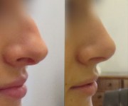 Rhinoplasty