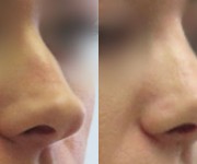 Rhinoplasty