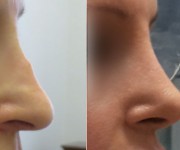 Rhinoplasty